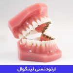 ارتودنسی لینگوال