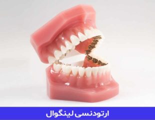 ارتودنسی لینگوال