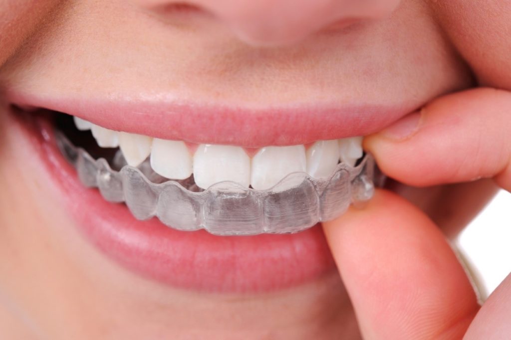 ارتودنسی دندان با کمترین هزینه