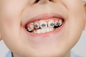 درمان ارتودنسی دندان بالا