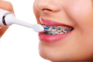 درمان ارتودنسی دندان بالا