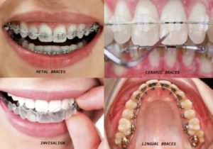 ارتودنسی دندان قیمت