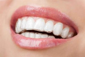 ارتودنسی دندان ژله ای-2