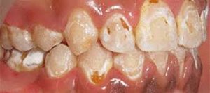 ارتودنسی دندان چه عوارضی دارد-2