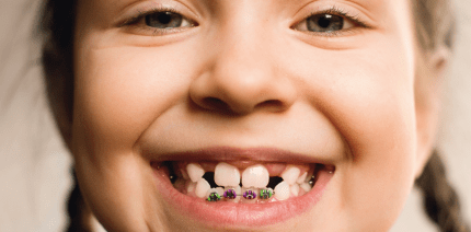 ارتودنسی چند دندان-1