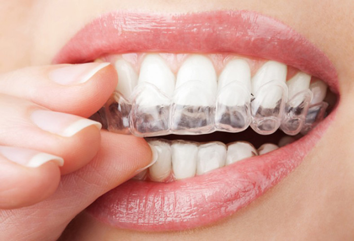 ارتودنسی دندان ژله ای-1