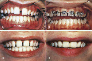 ارتودنسی فاصله دندان جلو-2