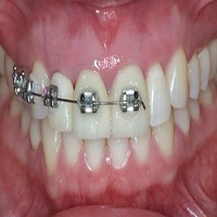 ارتودنسی دندان ایمپلنت شده