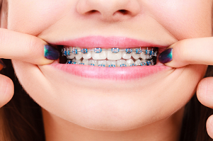 ارتودنسی دندان تا چه مدت طول میکشد؟