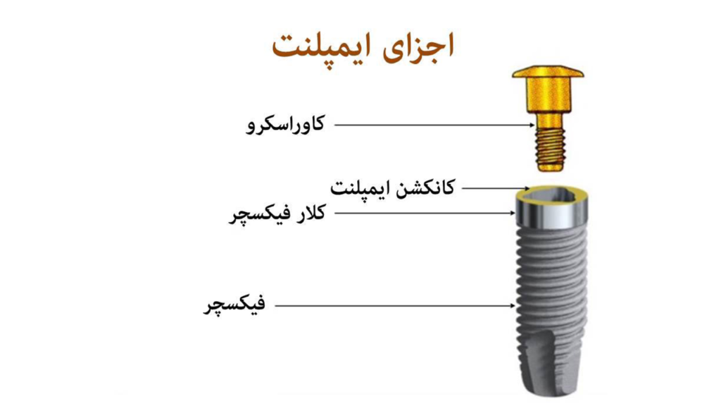 اجزای مختلف ایمپلنت دندان