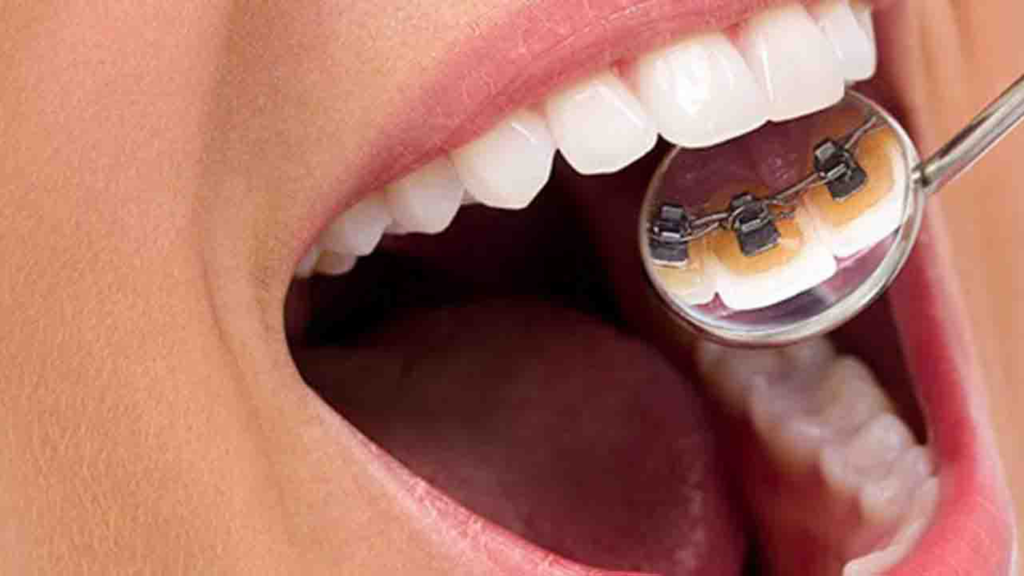 ارتودنسی ثابت با بریس های پشت دندانی