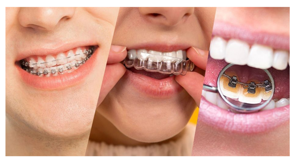ارتودنسی دندان و انواع دستگاه‌های ارتودنسی