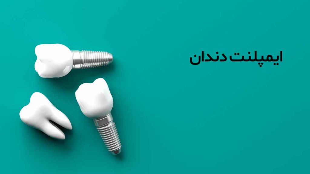 ایمپلنت دندان