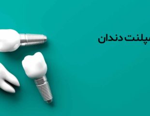 ایمپلنت دندان