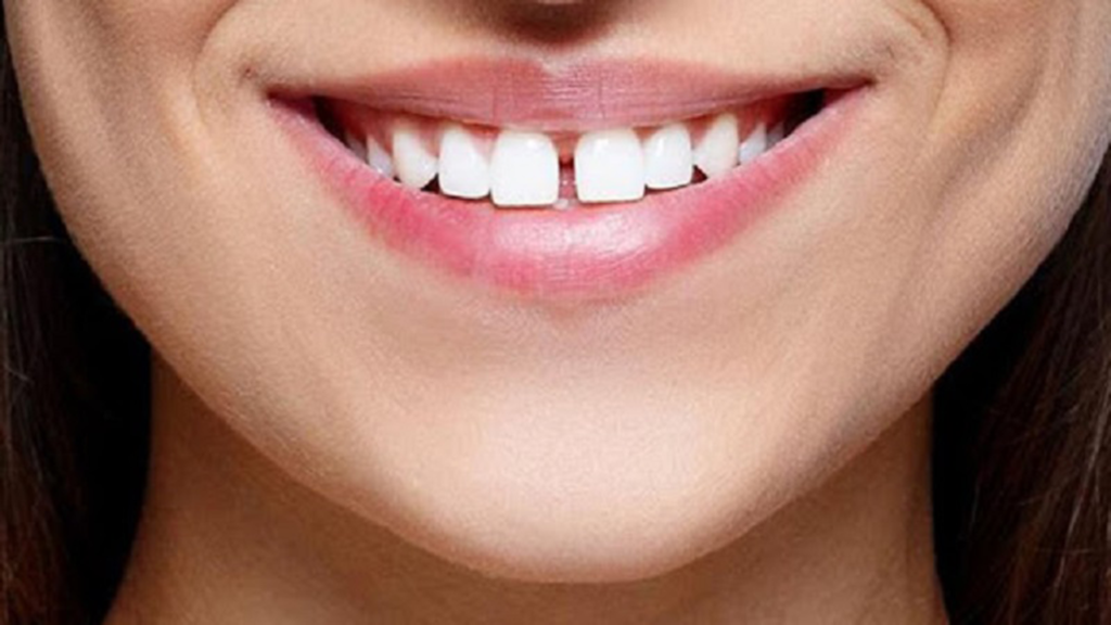 وجود فاصله بین دندان ها