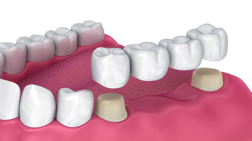 ۳ روش جایگزین دندان