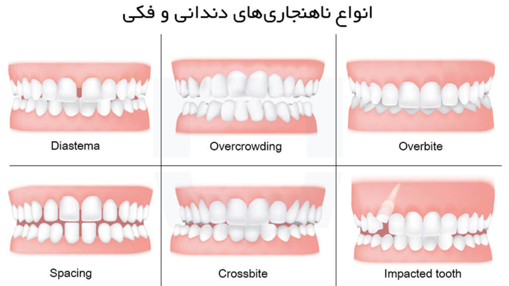 ناهنجاری دندان ها