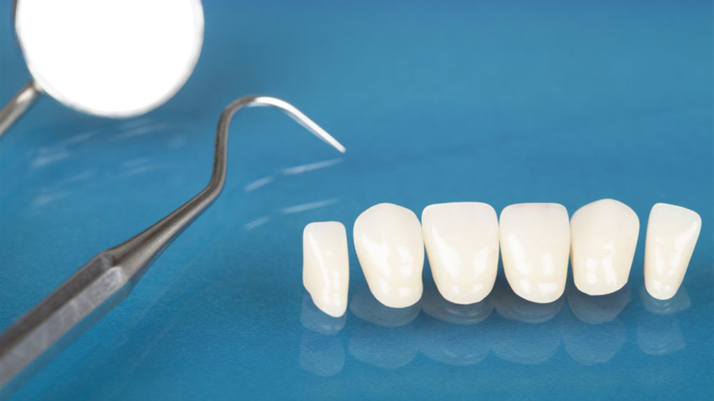 عوامل موثر در هزینه لمینت دندان