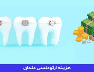 هزینه ارتودنسی دندان