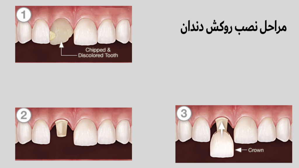 مراحل نصب روکش دندان