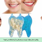 روکش دندان موقت
