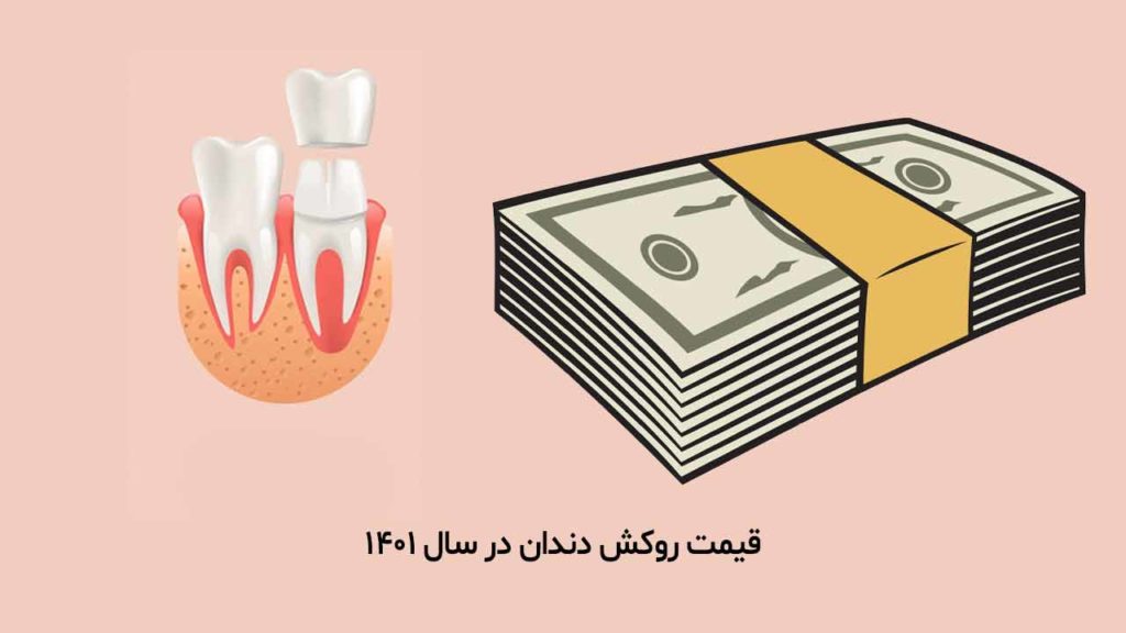 قیمت روکش دندان در سال 1401