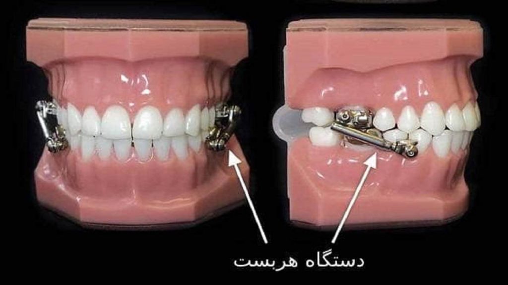 معایب ارتودنسی فانکشنال