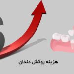 هزینه روکش دندان
