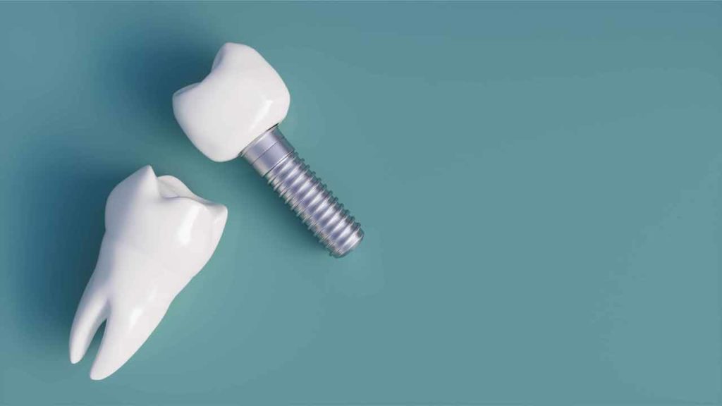 کاشت ایمپلنت دندان چقدر طول میکشد؟