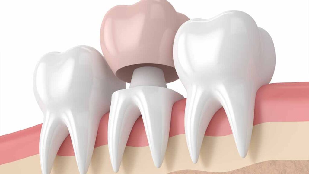 قیمت روکش دندان موقت در سال 1402