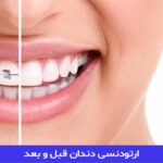 ارتودنسی دندان قبل و بعد